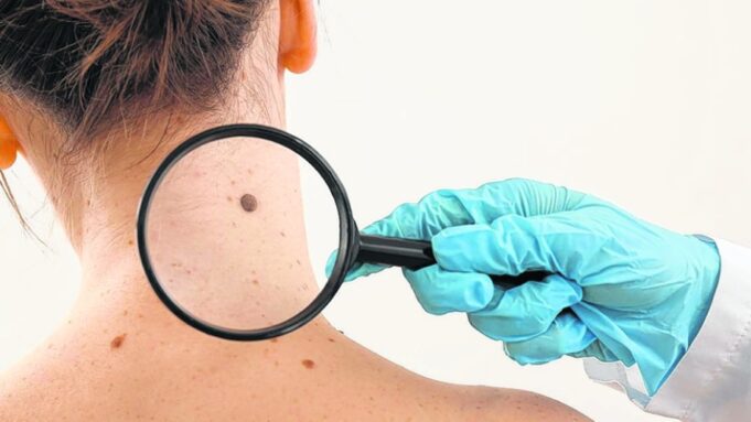 Desde el martes 16 hasta el 19 de noviembre se lleva a cabo la Semana de Prevención del Cáncer de Piel